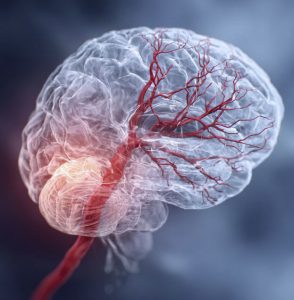 Рисунок поражённого участка мозга при инсульте.